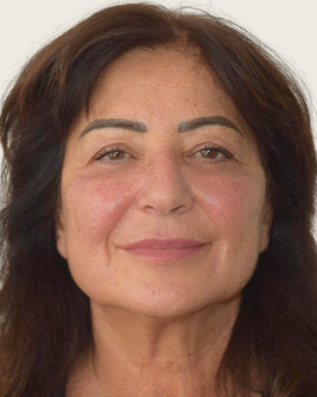 Dopo - Bioristrutturazione